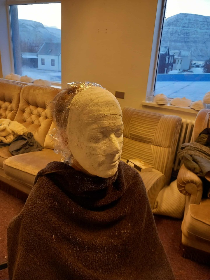 Sigga með gifsgrímu yfir andlitinu.